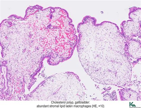 Pathology Outlines Cholesterol Polyp