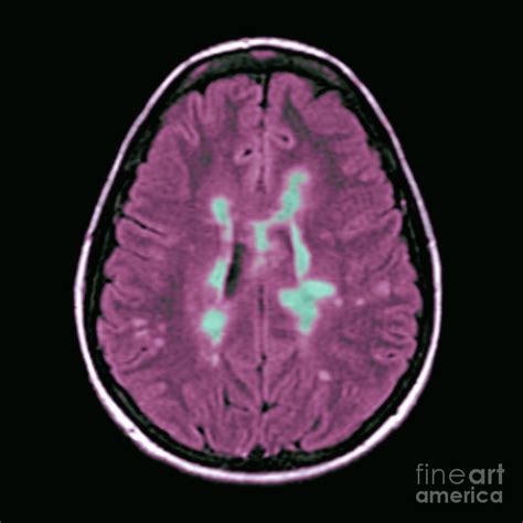 Mri Of Multiple Sclerosis Photograph By Medical Body Scans Pixels