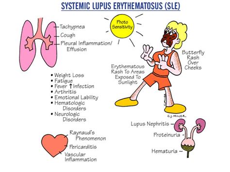 Nursing Guide Systemic Lupus Erythematosus Sle Studypk