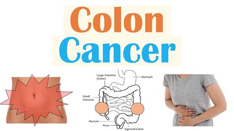 Colon Cancer Crc Risk Factors Pathogenesis Symptoms Diagnosis