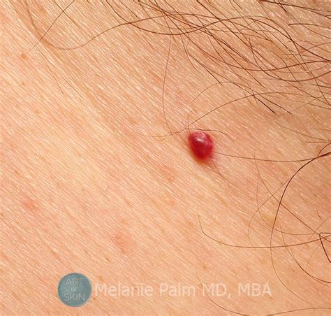 Cherry Angioma Scalp Raised Papule Nodule Smooth Pink Red Or Purple