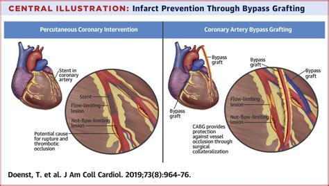 Pci And Cabg For Treating Stable Coronary Artery Disease
