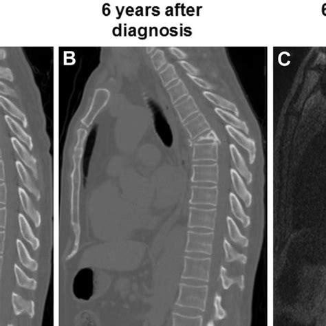 Pdf Stereotactic Spinal Radiosurgery And Delayed Vertebral Fracture Risk