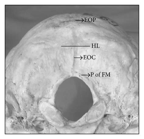 Occipital Emissary Foramina In South Indian Modern Human Skulls