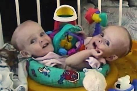 Facing The Unthinkable The Inspiring Journey Of Conjoined Twins Kendra
