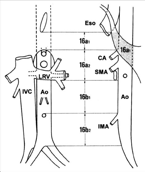 Para Aortic Lymph Node Removal