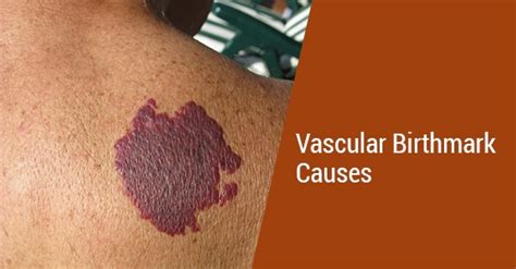 What Causes Vascular Birthmarks Fairview Laser Clinic Inc
