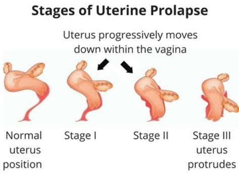 Uterine Prolapse Maa Si Care Foundation