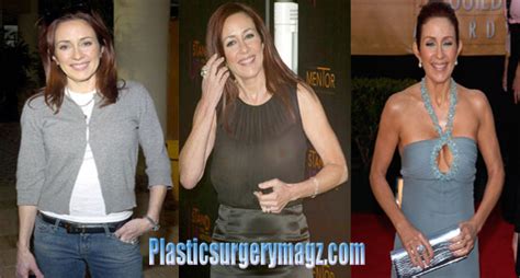 Patricia Heaton Plastic Surgery Before And After Plastic