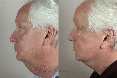 Facelift Before And After Photo Gallery Paramus Nj Parker Center