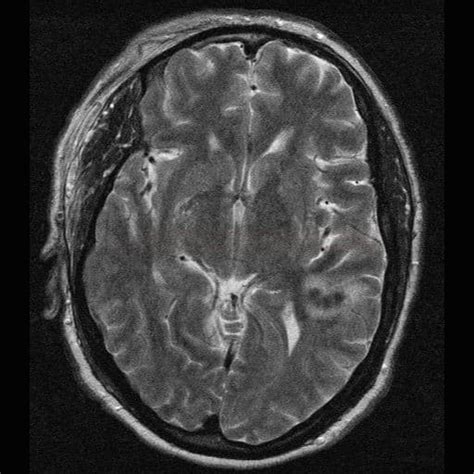 Cerebral Amyloid Angiopathy Caa Stroke Manual