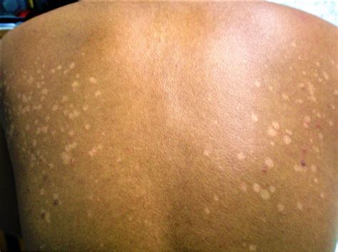 فطريات الجلد غير خطيرة لكن معدية وطريقة علاجها سهلة الميادين