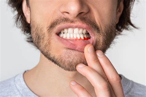 Bleeding Gums May Indicate A Dental Issue About Dental Care St
