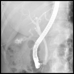 Endoscopic Retrograde Cholangiopancreatography Ercp Gastrodoctor