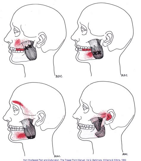Tmj Pain Jaw Pain Causes Symptoms Relation To Neck Pain
