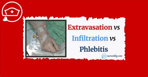Extravasation Vs Infiltration Vs Phlebitis Local Complications Of