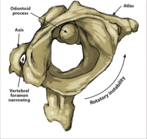 Cervical Instability Physiopedia