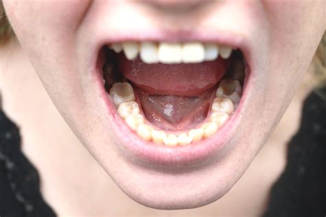 Gum Disease May Be Linked To Oral Cancer Aria Dental