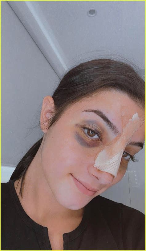 Full Sized Photo Of Charli Damelio Shares New Photos Post Nose Surgery
