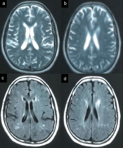 The Imaging Of The Patient Mri Showed Abnormal Signals In The