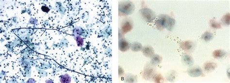 Urine Cytology Abdominal Key