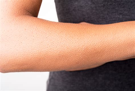 How To Treat Keratosis Pilaris Emedihealth