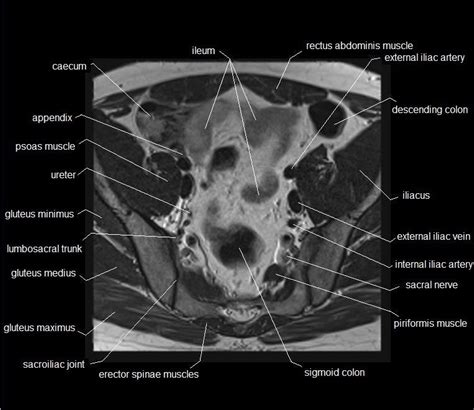 The muscle that forms the major part of the pelvic diaphragm. MRI pelvis anatomy | free male pelvis axial anatomy ...