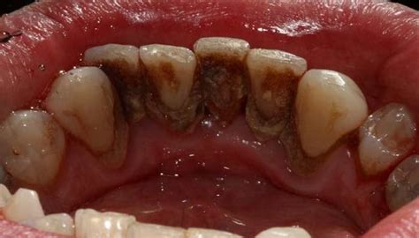 How Black Plaque On Teeth Causes Different Problems For Oral Health
