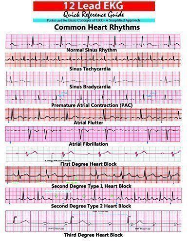 Cardiac Dysrrhythmia Aka Arrhythmia And Irregular Heartbeat