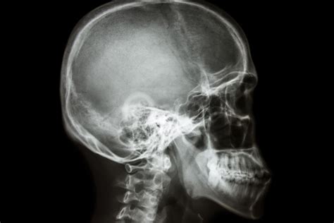 Teleradiografía lateral de cráneo Málaga Málaga Clínicas Rincón Dental