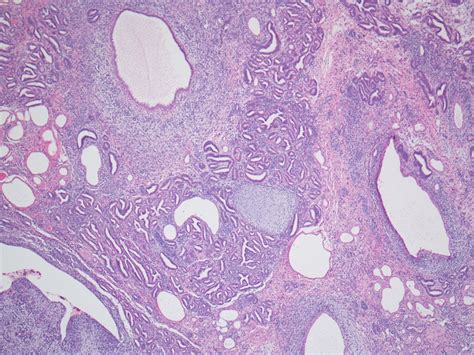 Pathology Outlines Nephroblastomatosis Nephrogenic Rests