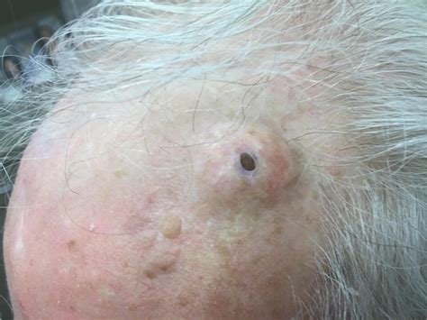 Dilated Pore Of Winer Definition Causes Symptoms Diagnosis And Treatment