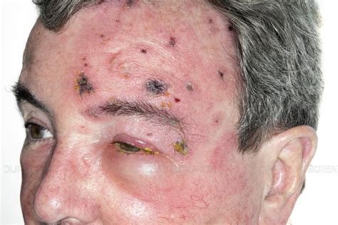 Science Source Shingles Rash On The Face