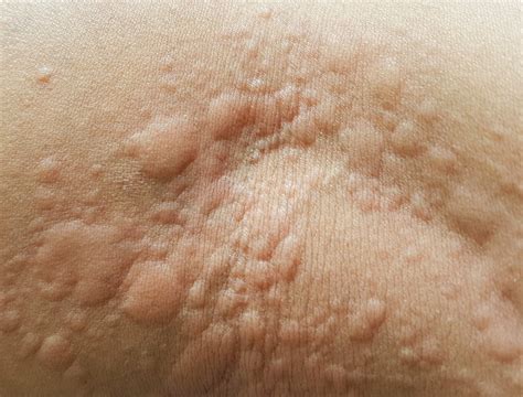 What Are Hives The Common Skin Condition That Gives You Itchy Red Bumps