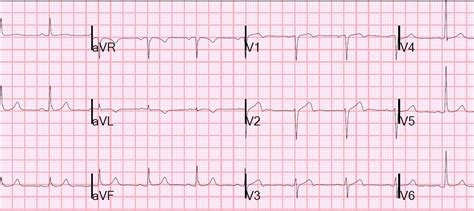 Dr Smith S ECG Blog Wellens Syndrome No Culprit What Happened