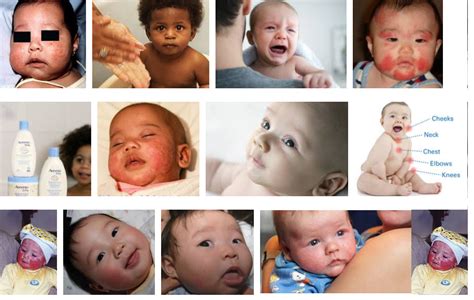 What Causes Eczema In Babies Symptoms Triggers And Treatments