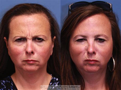 Dysport Before And After Core Plastic Surgery