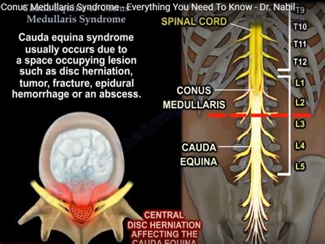 Cauda Equina Syndrome Vs Conus Medullaris Syndrome