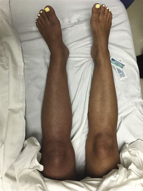 Woman With Left Leg Pain And Swelling Annals Of Emergency Medicine