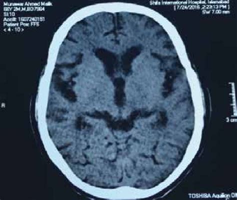 Ct Scan Brain Of The Patient Which Was Normal He Started Having