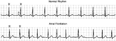 Electrocardiogram For Sinus Rhythm Top And Atrial Fibrillation