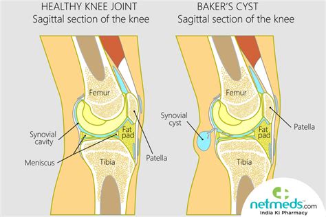 Bakers Cyst Causes Symptoms And Treatment