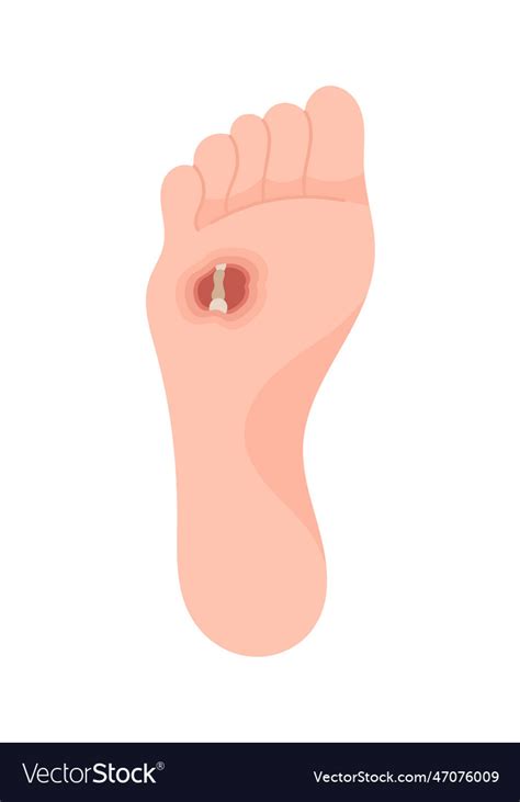 Abscess Osteitis Foot Disease Royalty Free Vector Image