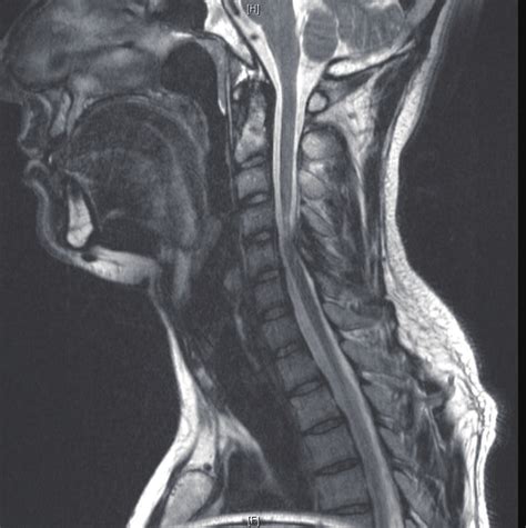 Sagittal T Weighted MR Image Of The Cervical Spine Showing A Narrowed Download Scientific