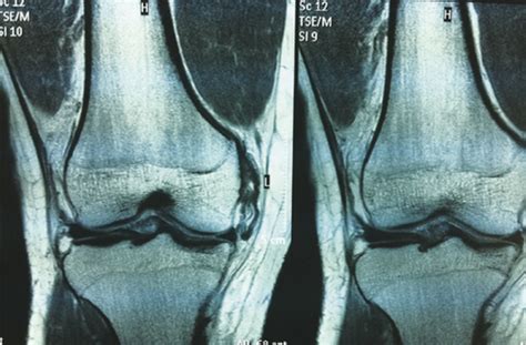 Coronal View Of The Knee Showing Medial Collateral Ligament Tear With