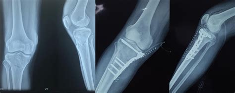 Fixation Of Distal Tibial Fractures With Intraarticular Extension Using Images And Photos Finder