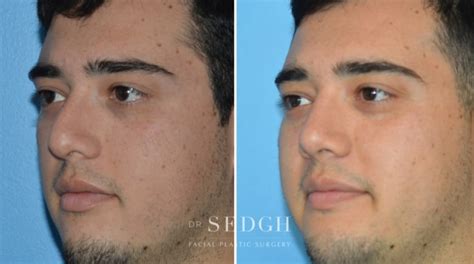 Crooked Nose Surgery Before And After Sedgh