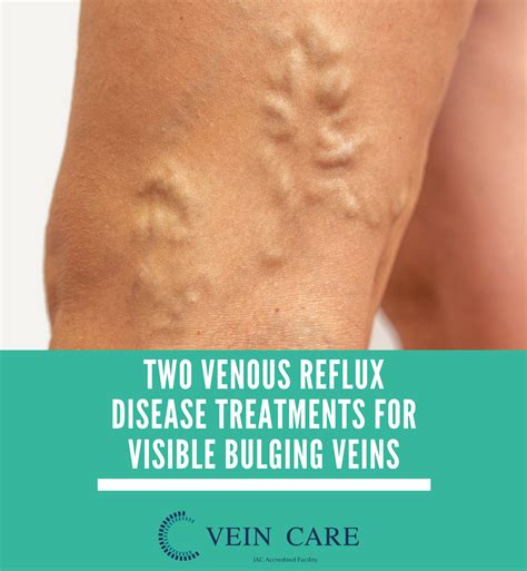 Two Venous Reflux Disease Treatments For Visible Bulging Veins