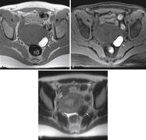 Magnetic Resonance Imaging Of The Female Pelvis Technique Anatomy Porn Sex Picture