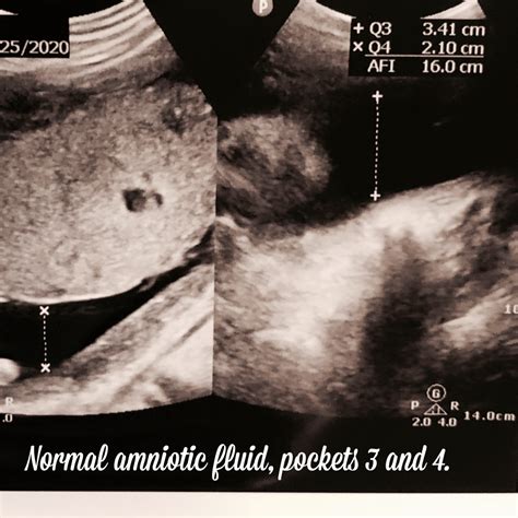All You Need To Know About Amniotic Fluid Ultrasoundfeminsider